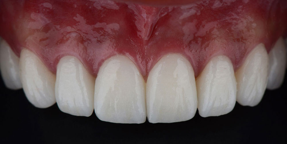 Faccette Dentali - Studio Dentistico Loglisci Gattullo